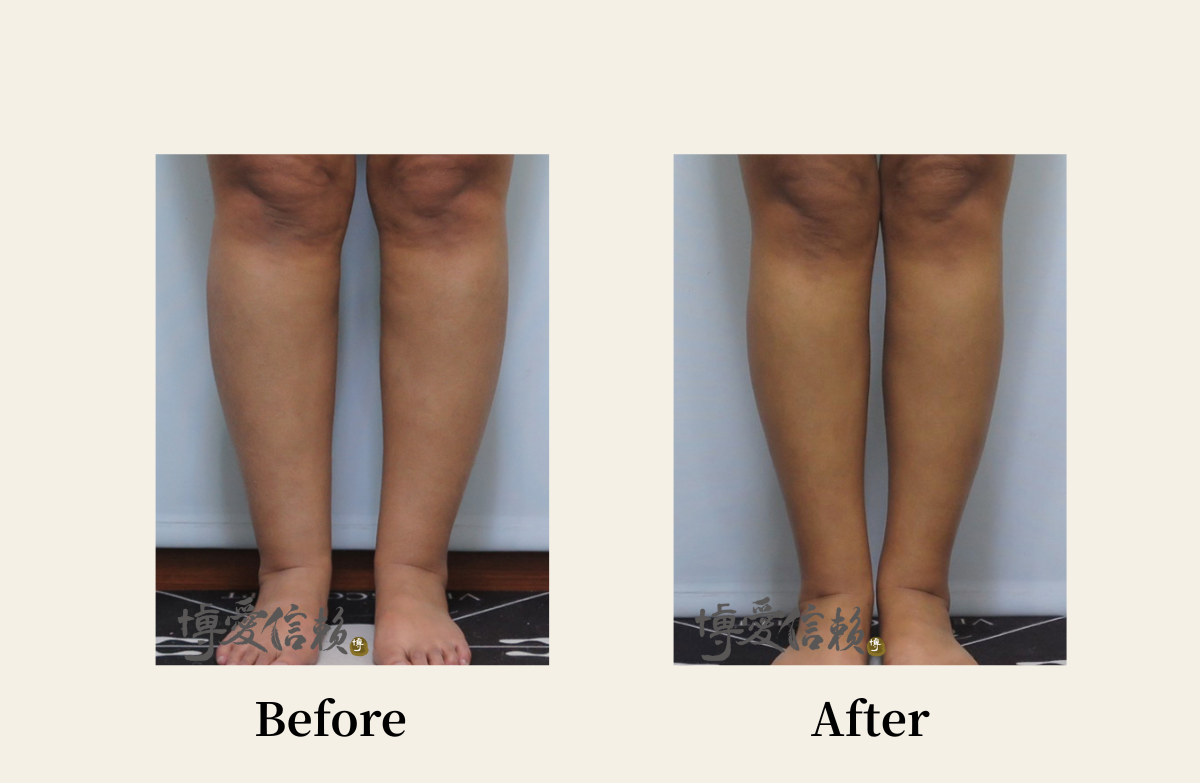 威塑抽脂－小腿抽脂案例-1
