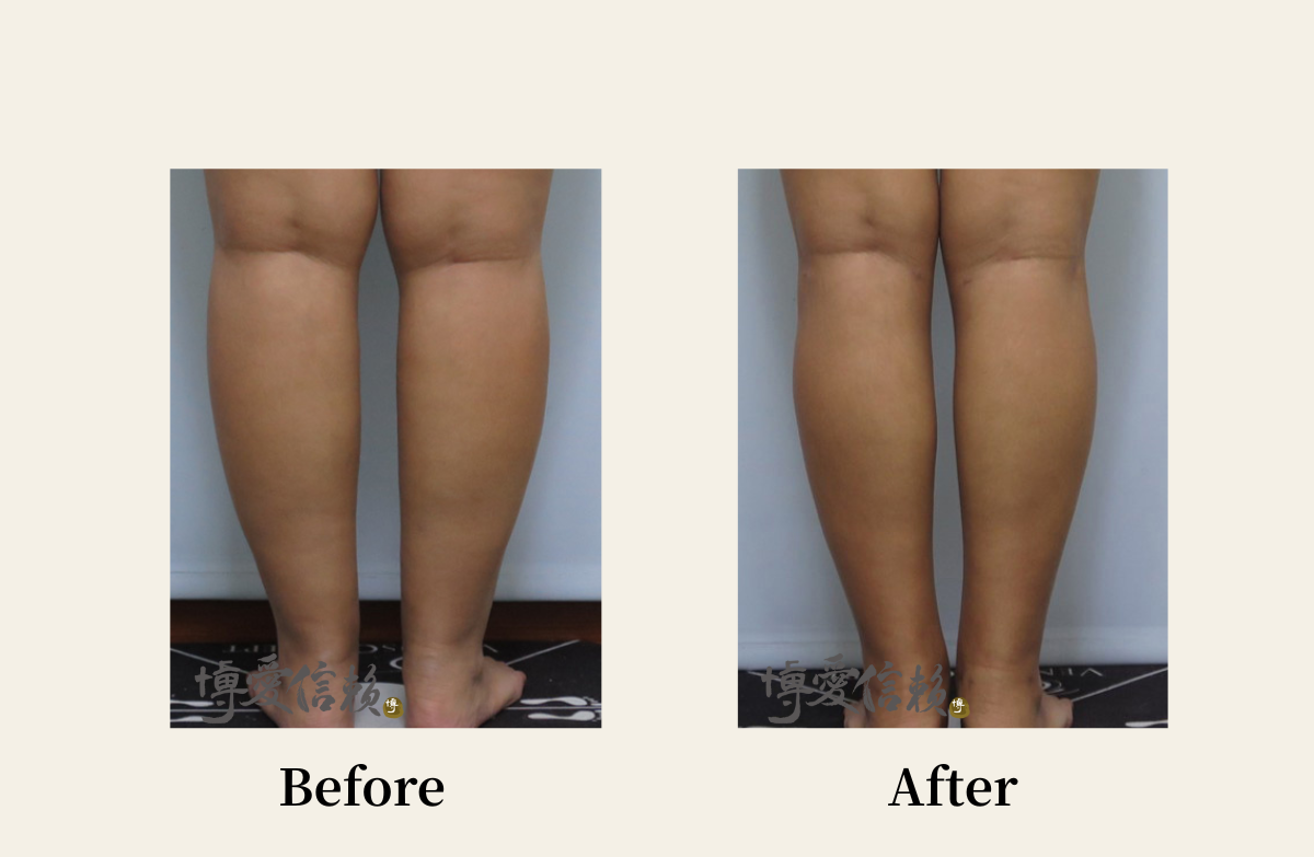 威塑抽脂－小腿抽脂案例-2