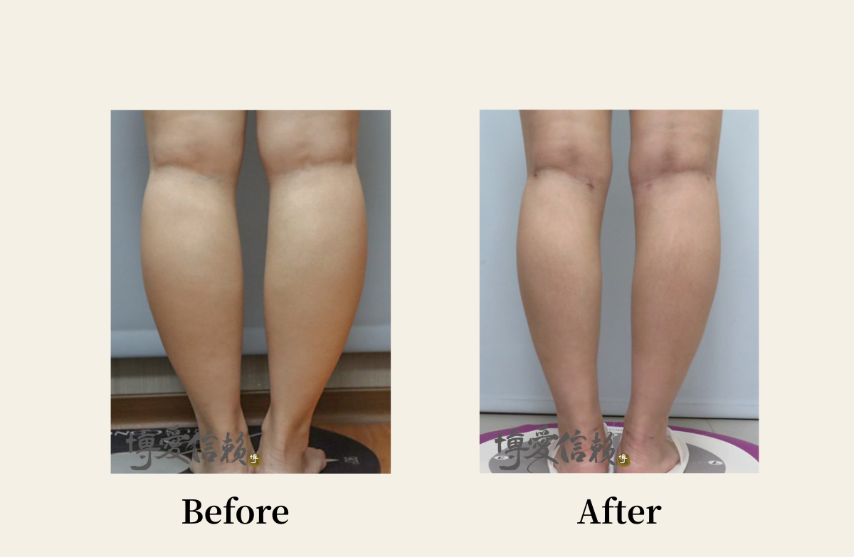 威塑抽脂－小腿抽脂案例-3