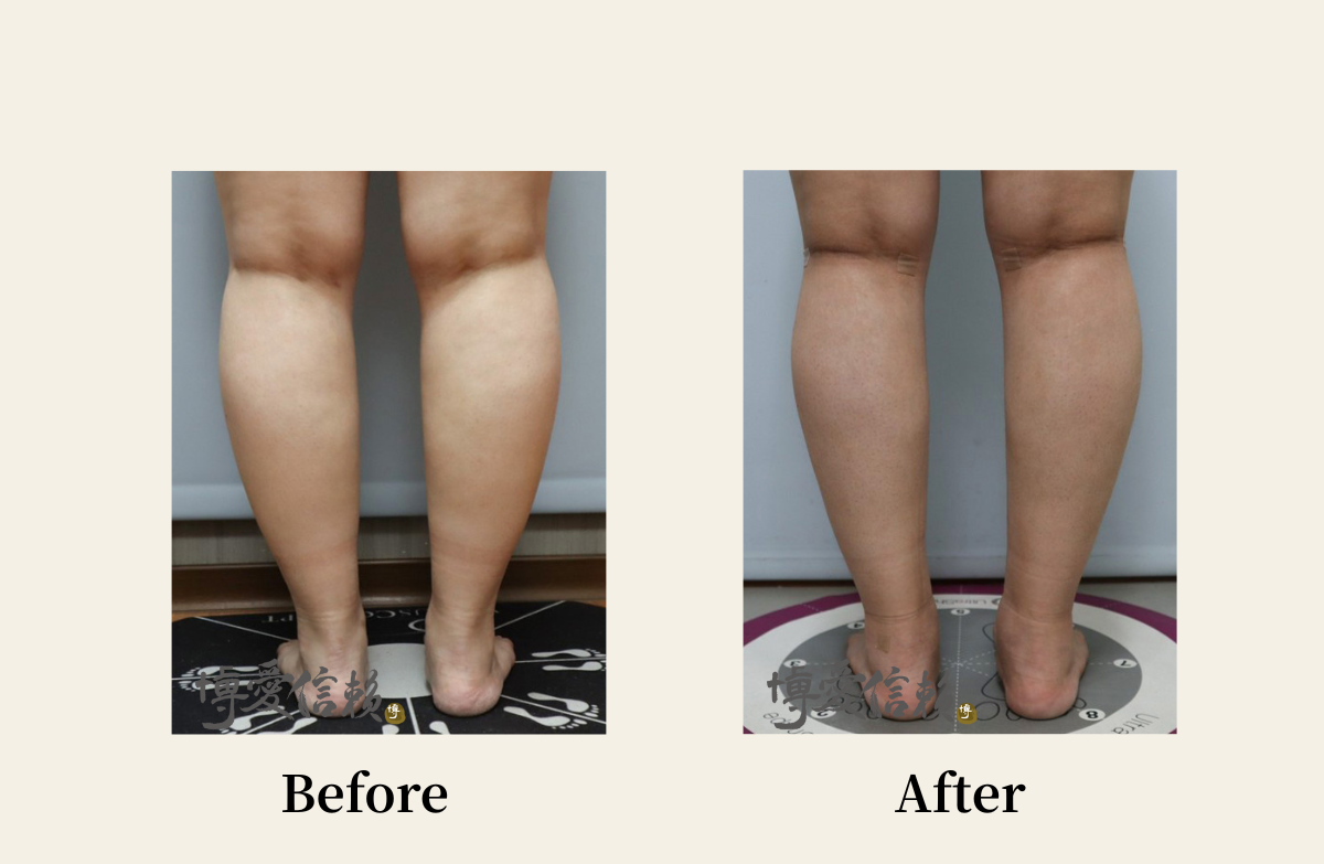 威塑抽脂－小腿抽脂案例-4