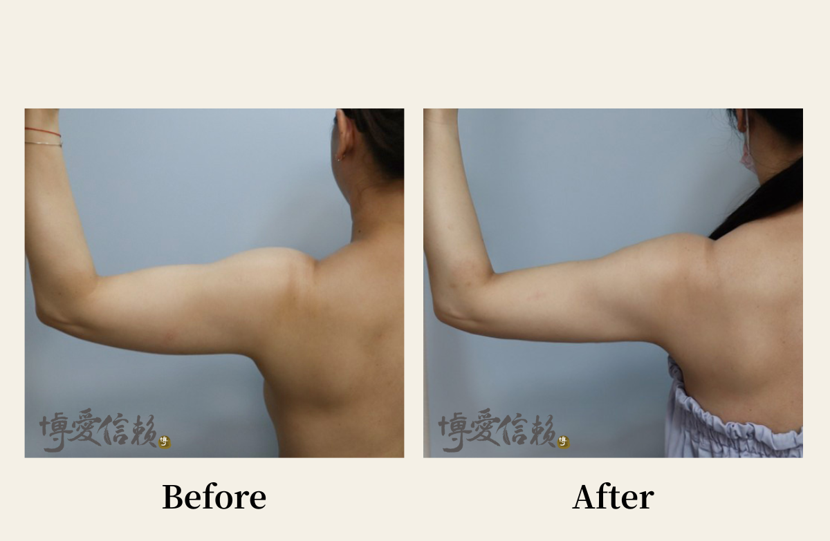 威塑抽脂－手臂抽脂案例 (2)
