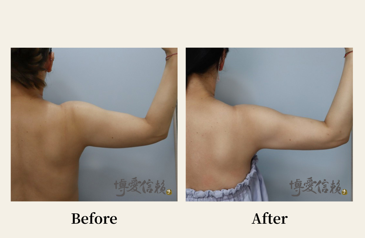 威塑抽脂－手臂抽脂案例 (3)