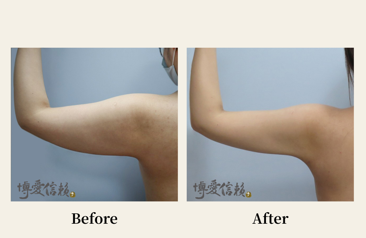 威塑抽脂－手臂抽脂案例