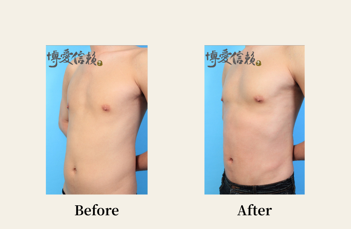 威塑抽脂－男性腹部抽脂案例 (1)