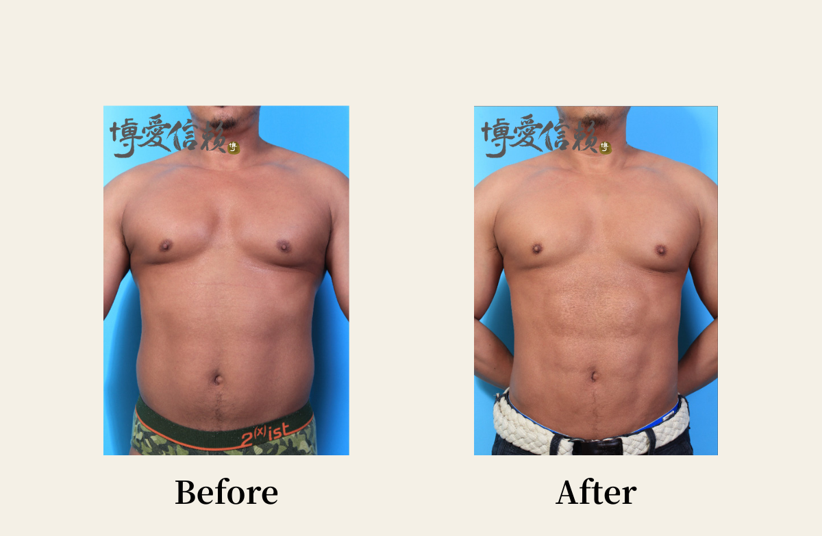 威塑抽脂－男性腹部抽脂案例 (2)