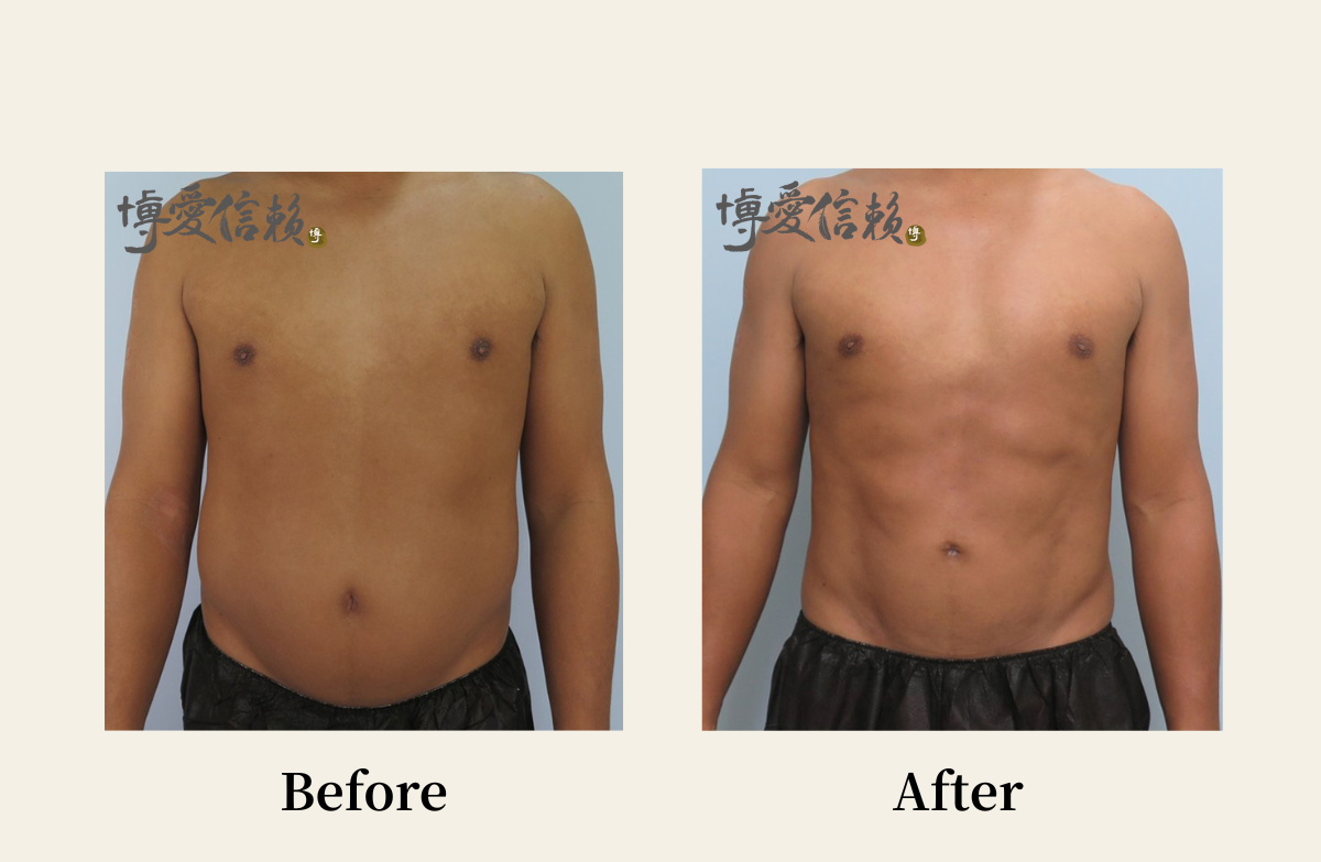 威塑抽脂－男性腹部抽脂案例 (3)