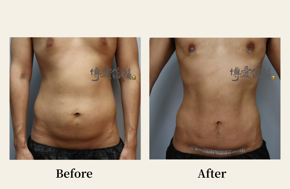 威塑抽脂－男性腹部抽脂案例 (5)