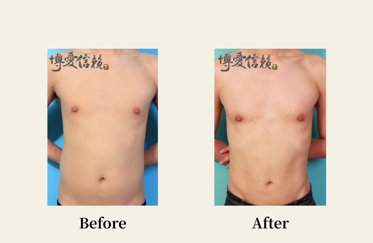 威塑抽脂－男性腹部抽脂案例