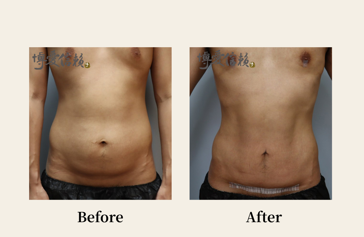 拉皮專區 - 腹部拉皮案例