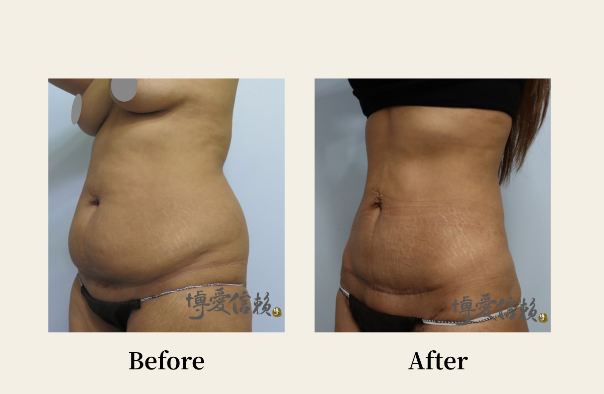 拉皮專區 - 腹部拉皮案例(3)