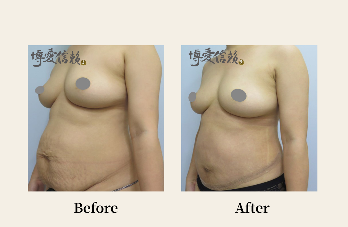 拉皮專區 - 腹部拉皮案例(4)