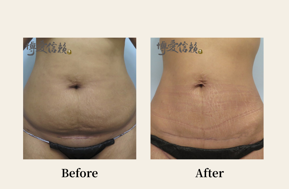 拉皮專區 - 腹部拉皮案例(5)