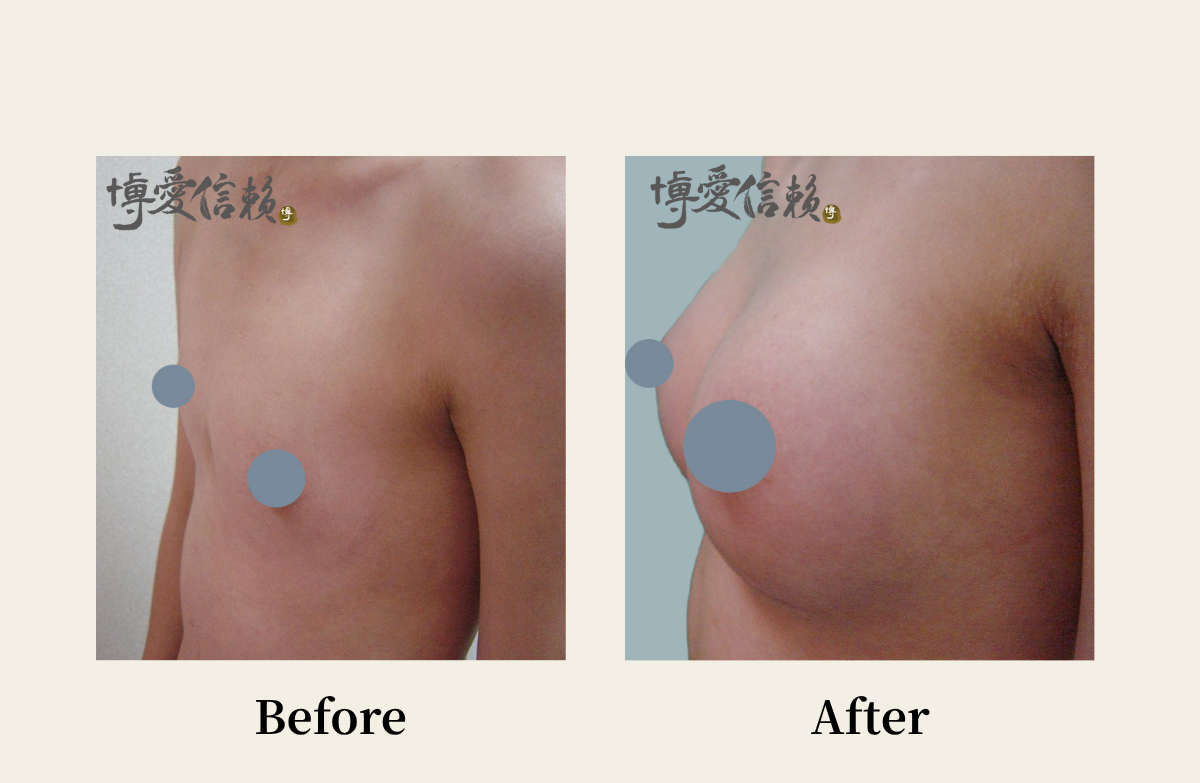 胸部專區 - 假體隆乳案例