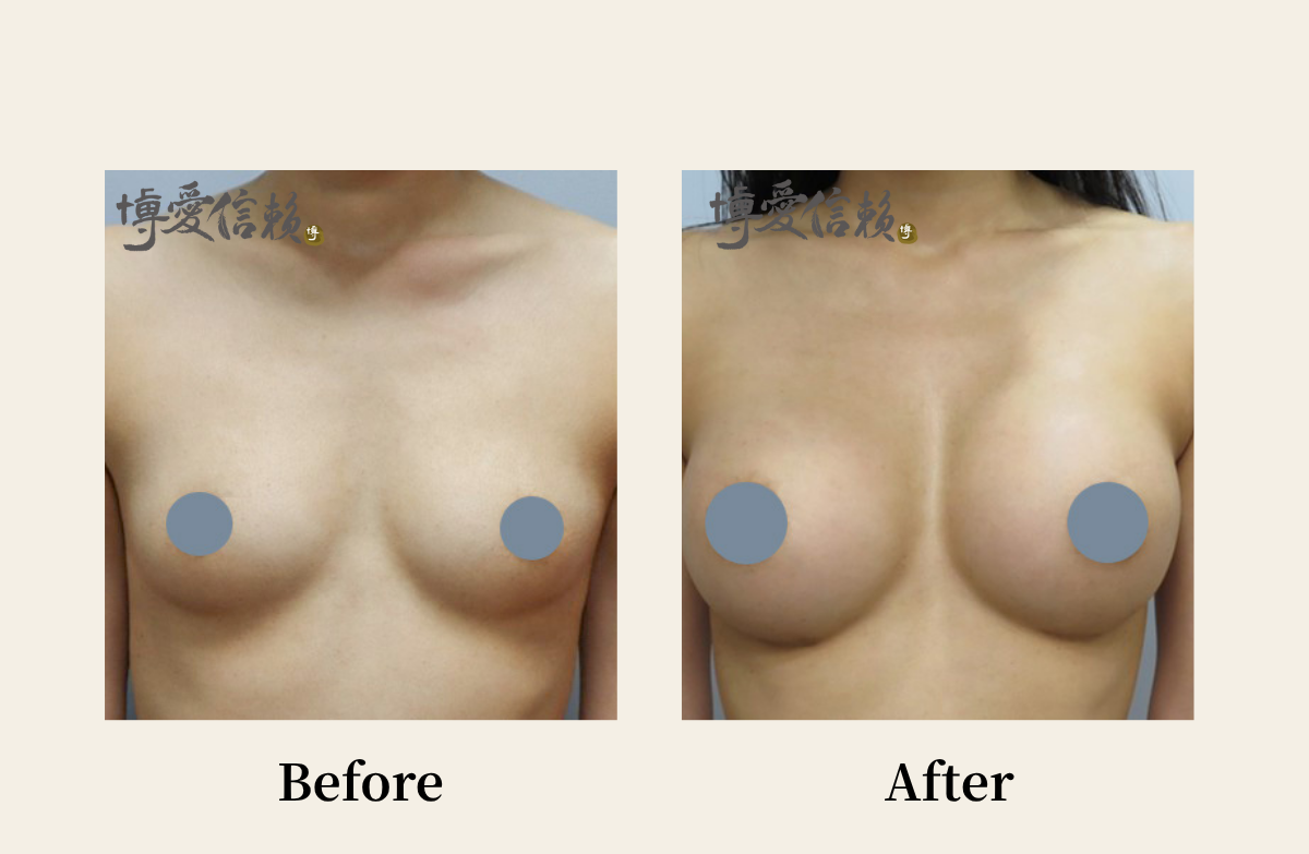 胸部專區 - 假體隆乳案例(1)