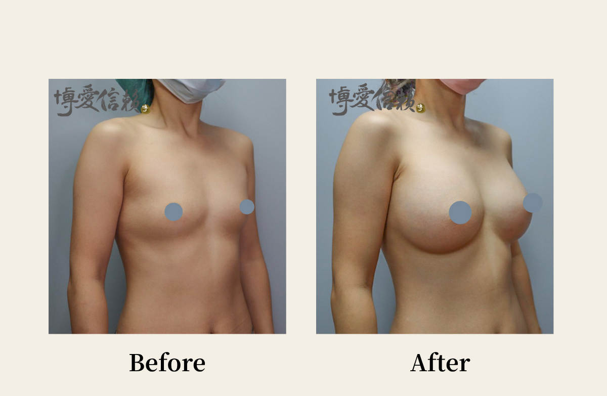 胸部專區 - 假體隆乳案例(2)