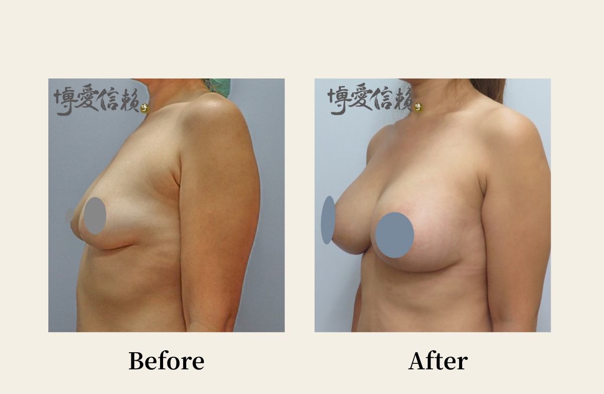 胸部專區 - 假體隆乳案例(3)