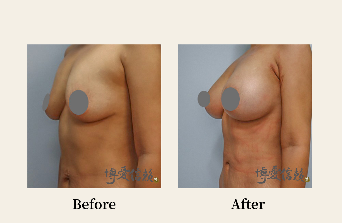 胸部專區 - 假體隆乳案例(4)