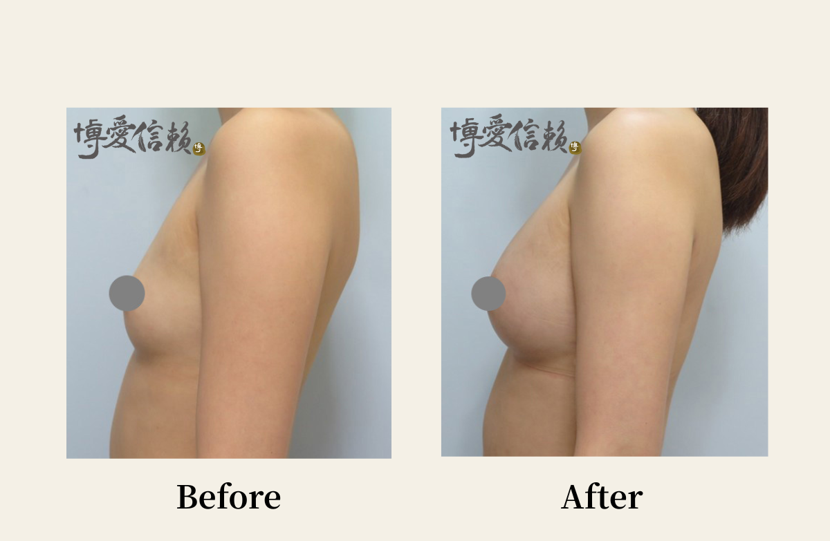 自體脂肪專區-自體脂肪隆乳案例