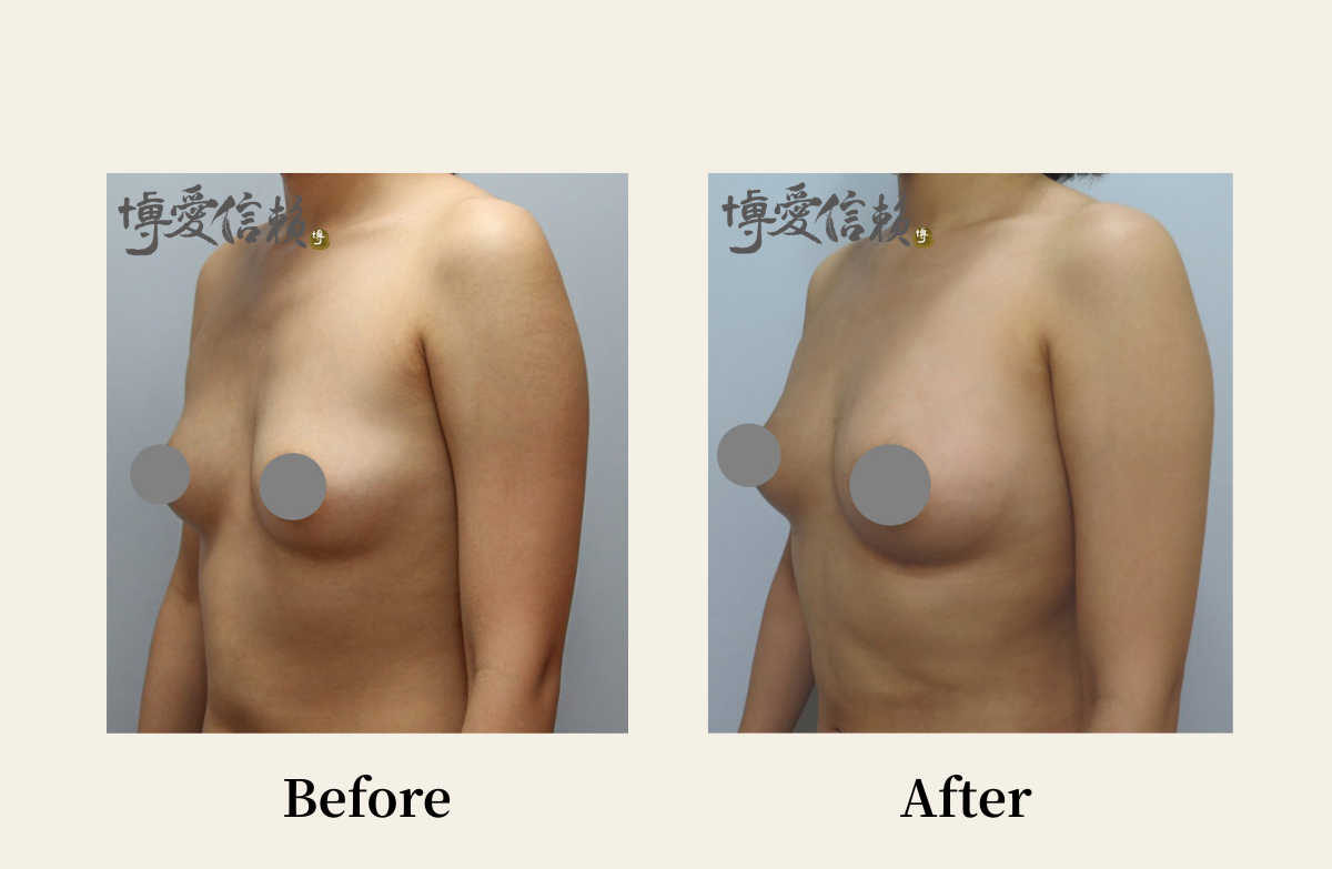 自體脂肪專區-自體脂肪隆乳案例(1)