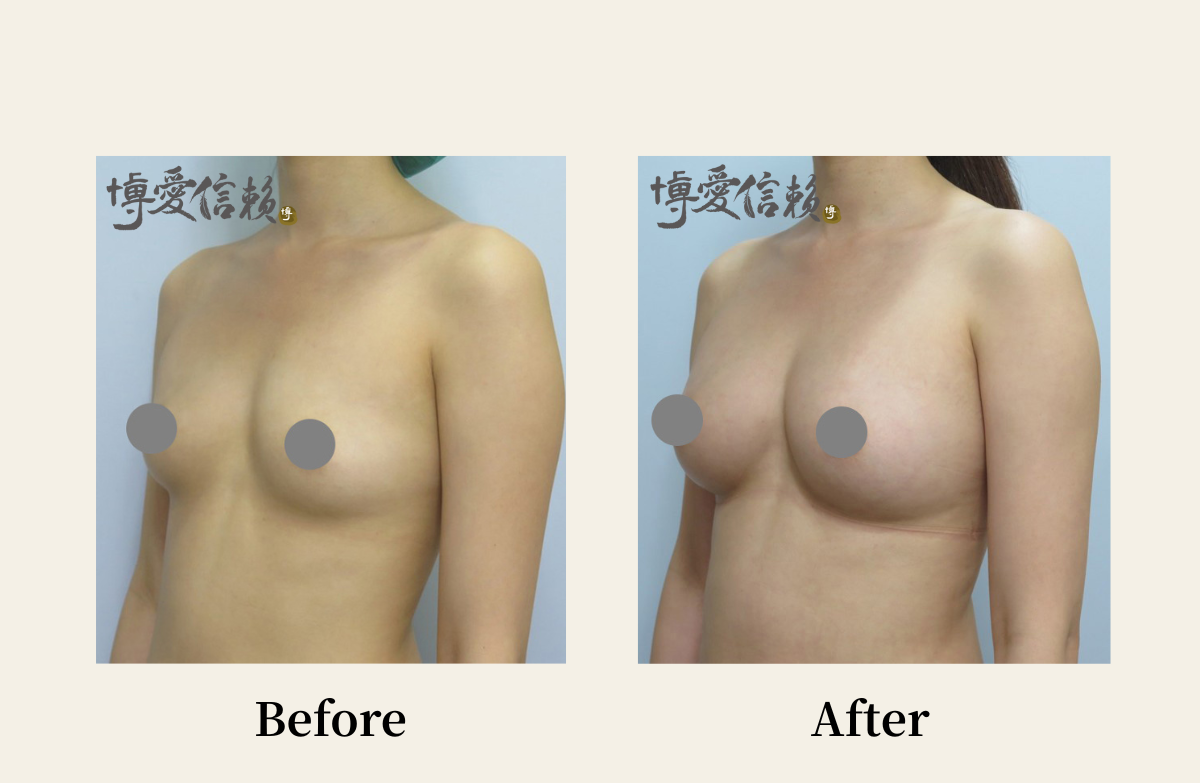 自體脂肪專區-自體脂肪隆乳案例(4)