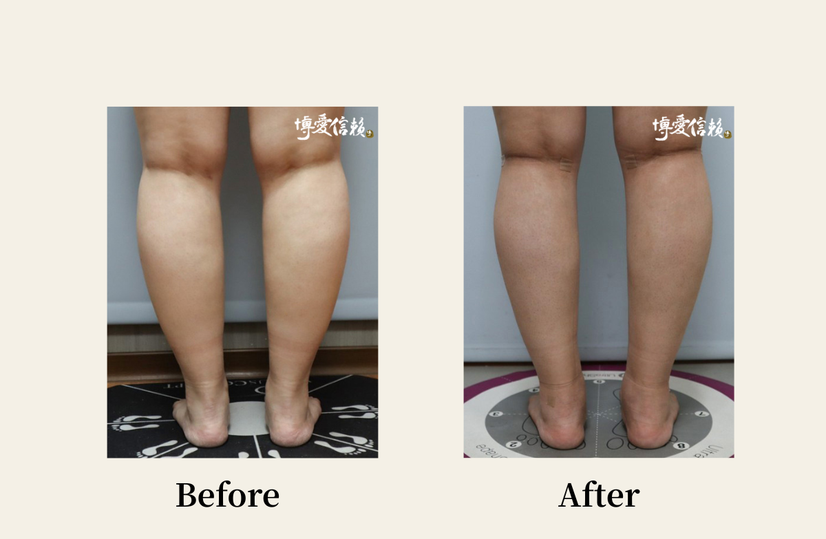威塑抽脂－小腿抽脂案例