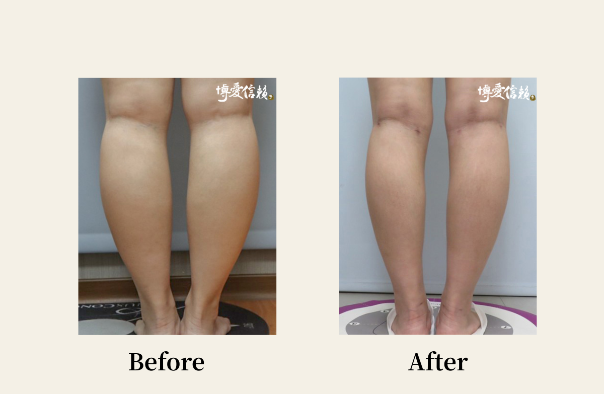 威塑抽脂－小腿抽脂案例(1)
