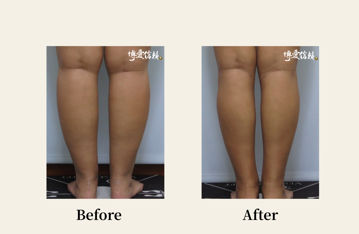 威塑抽脂－小腿抽脂案例(2)