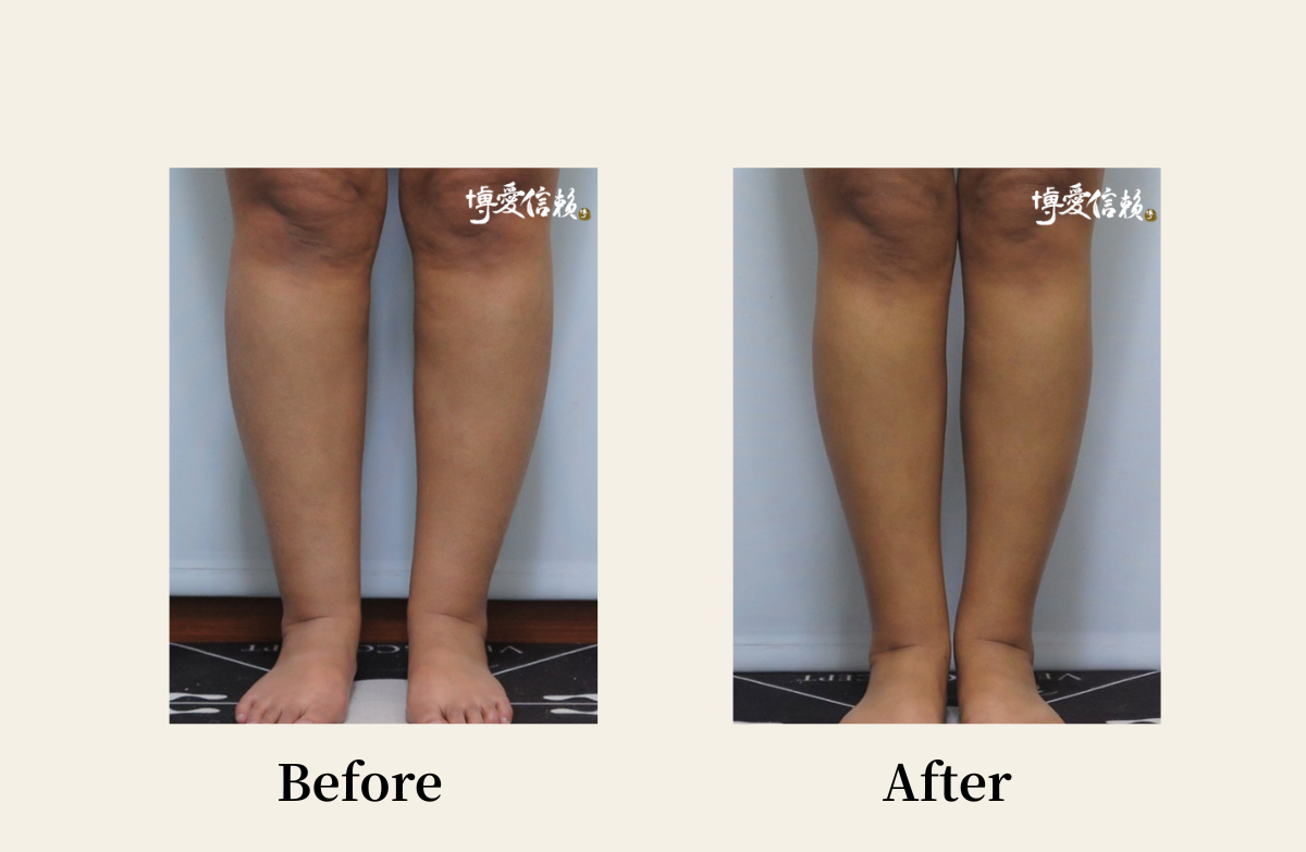 威塑抽脂－小腿抽脂案例(3)