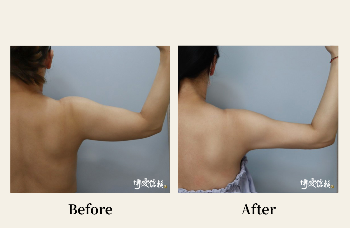 威塑抽脂－手臂抽脂案例