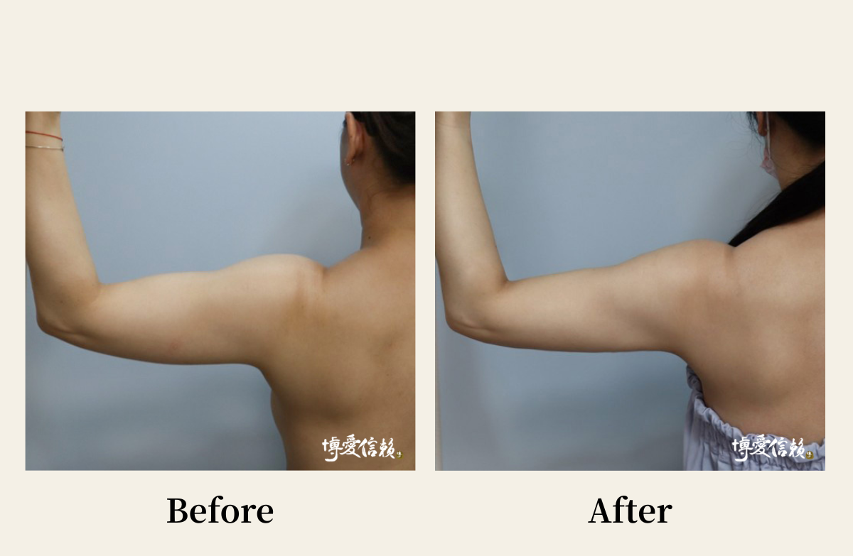 威塑抽脂－手臂抽脂案例(1)