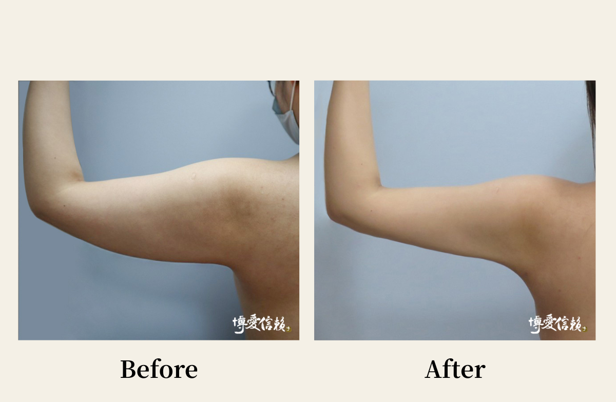 威塑抽脂－手臂抽脂案例(3)