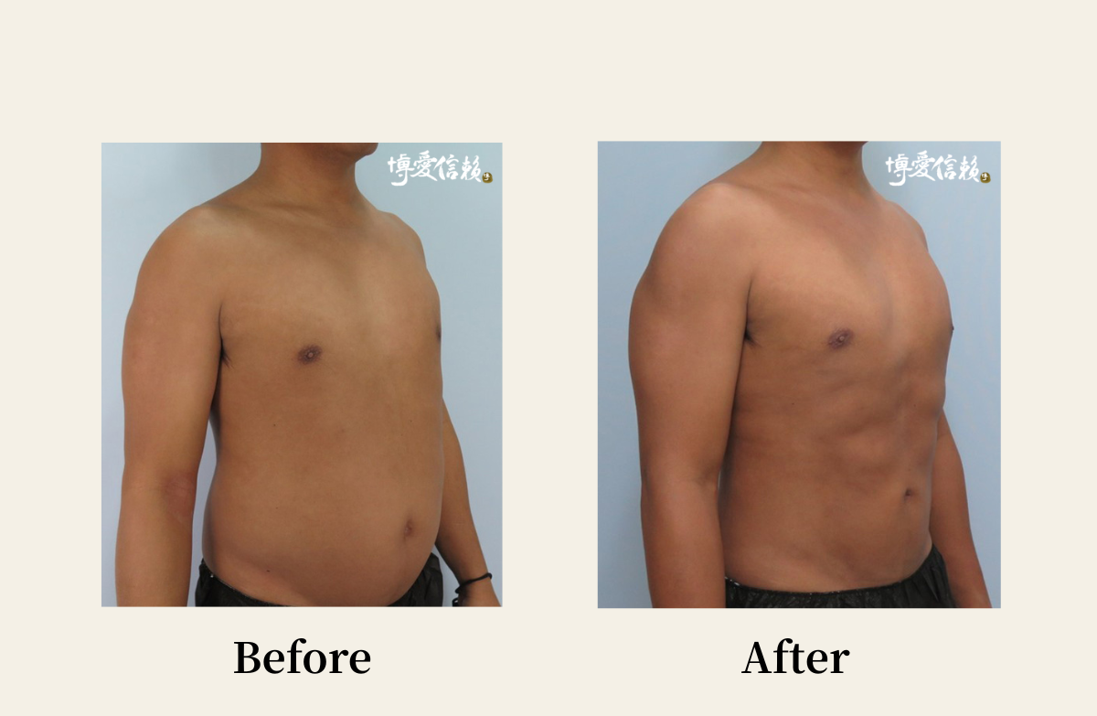 威塑抽脂－男性腹部抽脂案例(2)