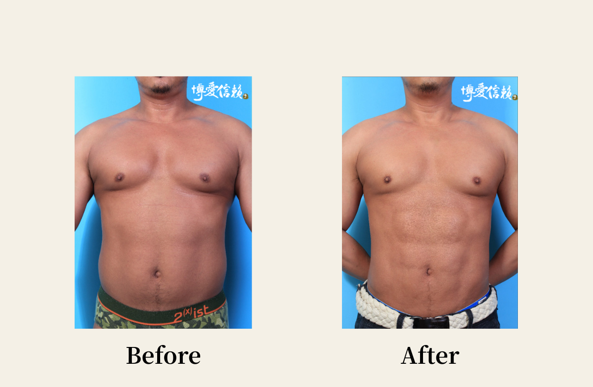 威塑抽脂－男性腹部抽脂案例(4)