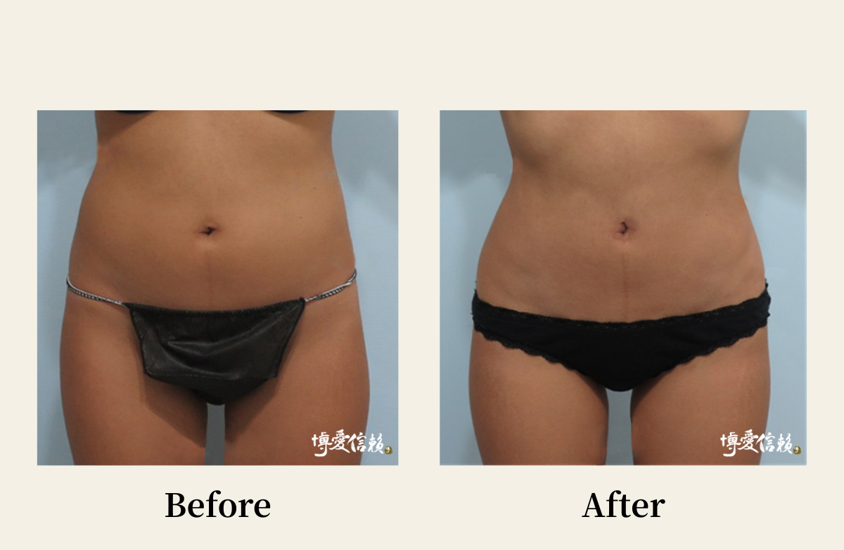 威塑抽脂－腰腹部抽脂案例(3)