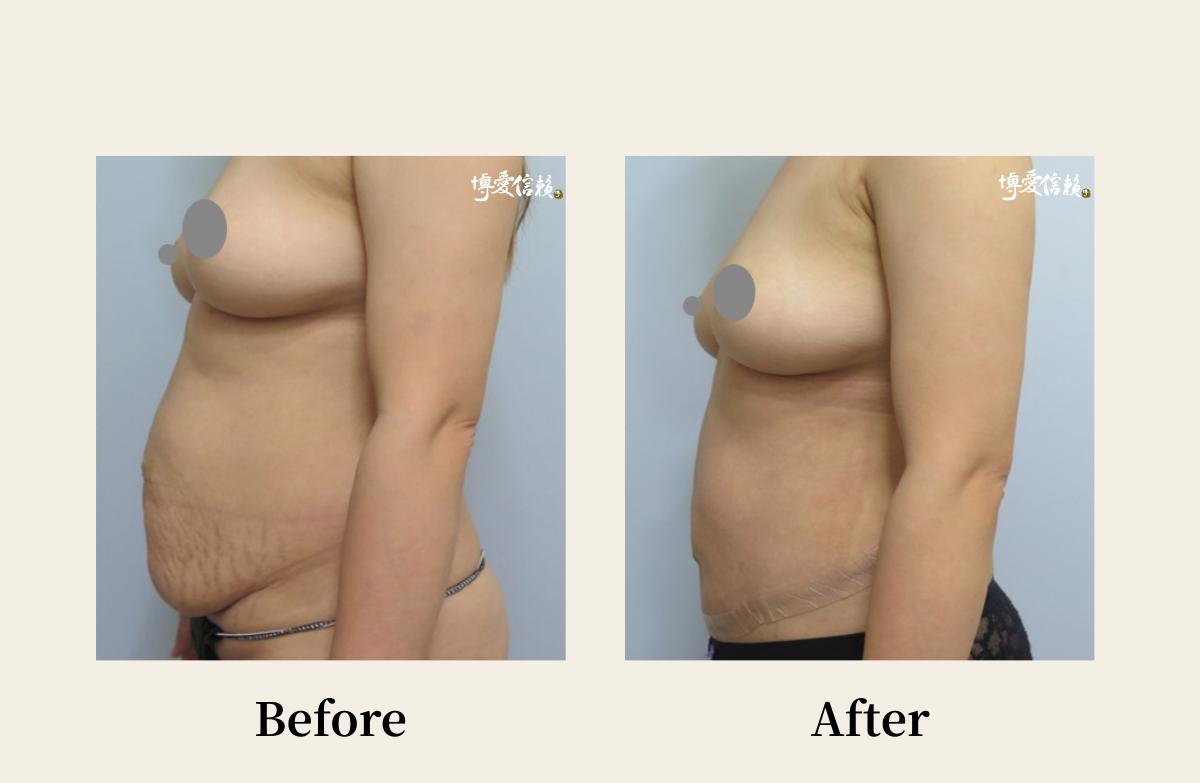 拉皮專區 - 腹部拉皮案例(2)