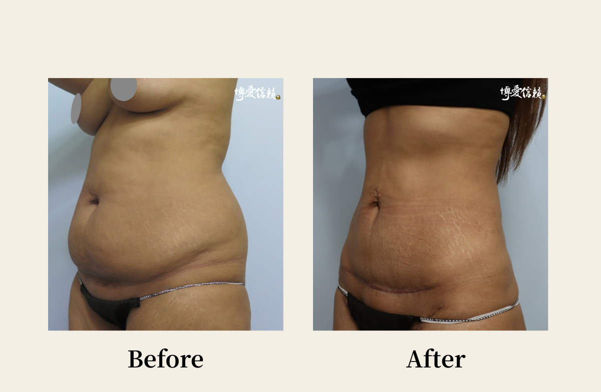 拉皮專區 - 腹部拉皮案例(4)