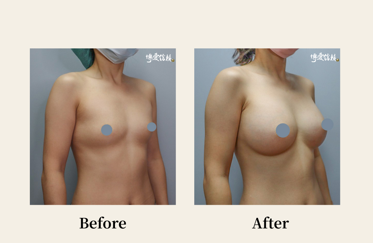 胸部專區 - 假體隆乳案例(2)