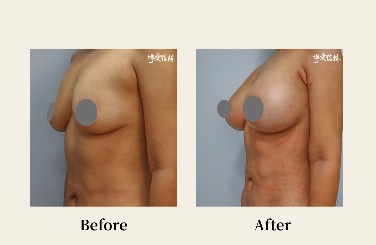 胸部專區 - 假體隆乳案例(3)