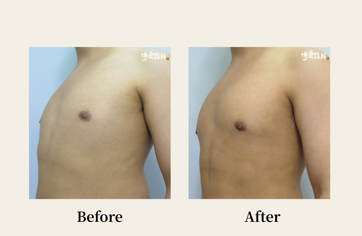胸部專區 - 胸肌雕塑案例 (2)