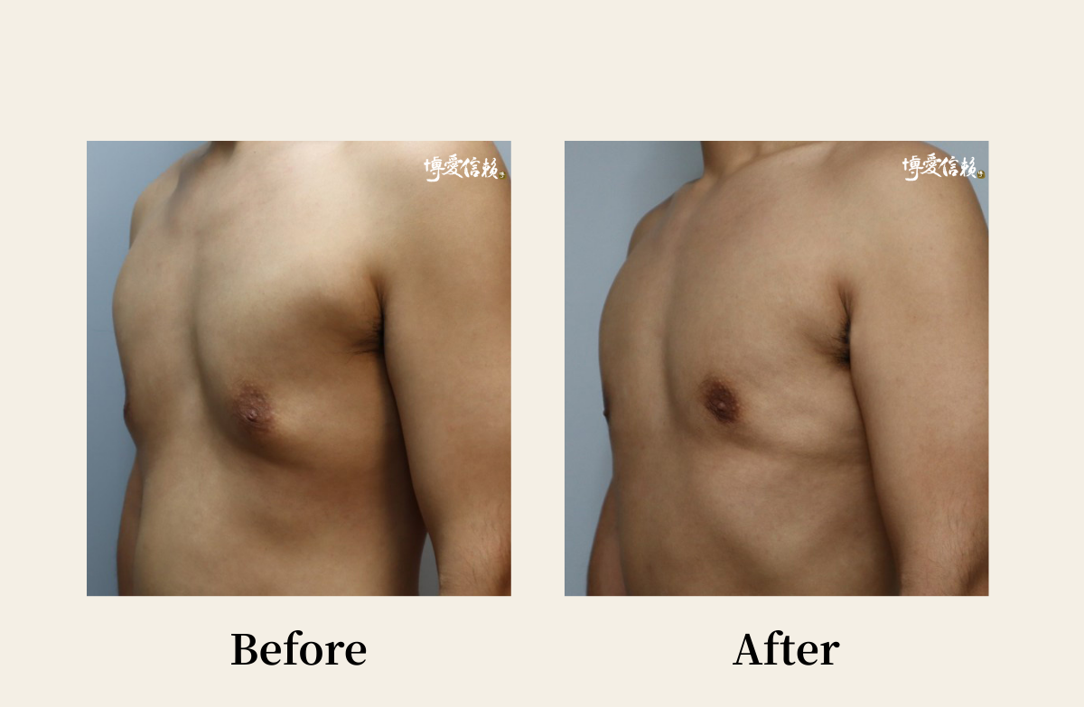 胸部專區 - 胸肌雕塑案例