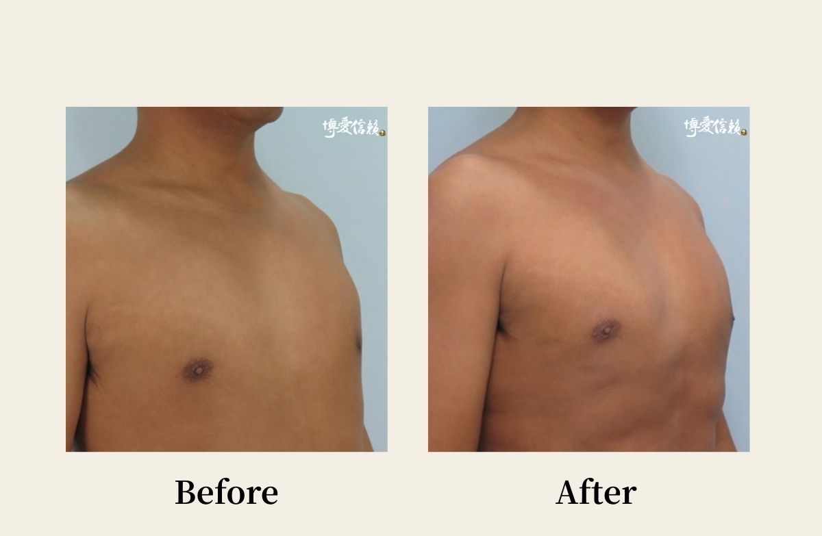 胸部專區 - 胸肌雕塑案例 (3)