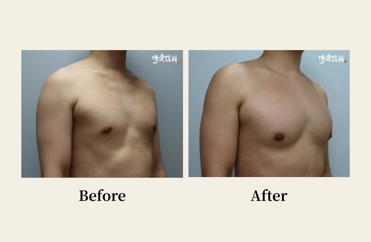 胸部專區 - 胸肌雕塑案例 (4)